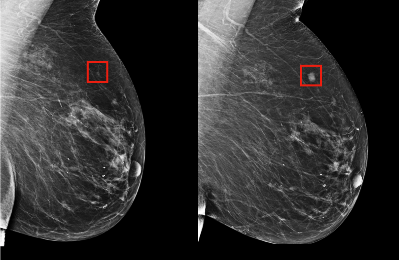 A Tool for Early Breast Cancer Screening